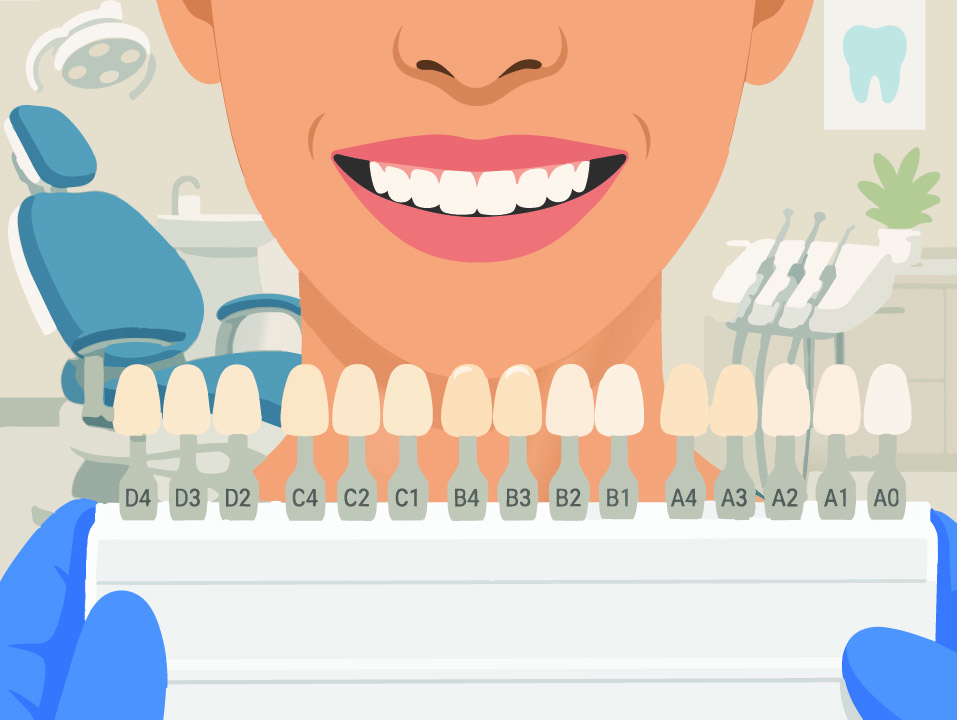 Veeners in a row being held up towards patient's teeth